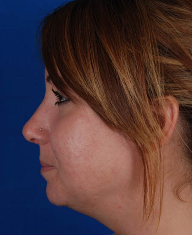 Rhinoplasty Before & After Gallery - Patient 12974047 - Image 2