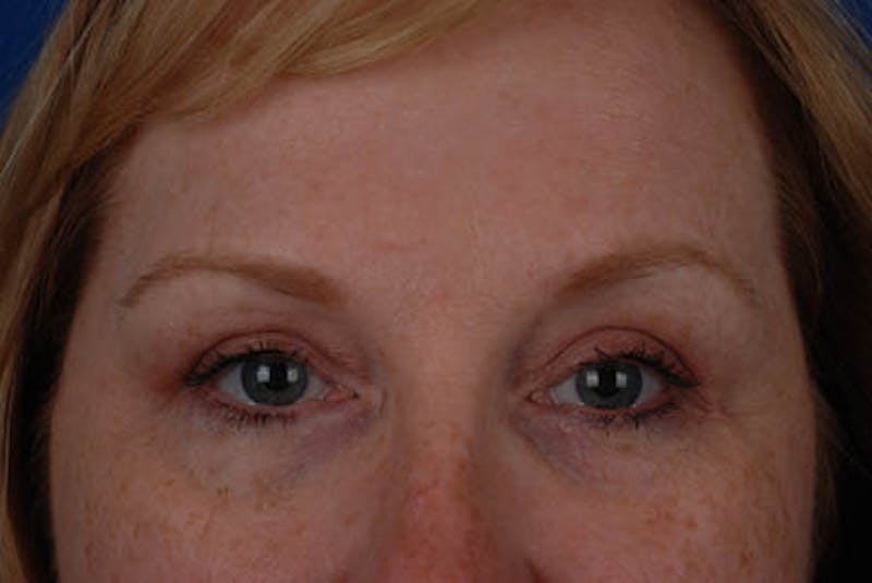 Upper Blepharoplasty Before & After Gallery - Patient 12974045 - Image 2