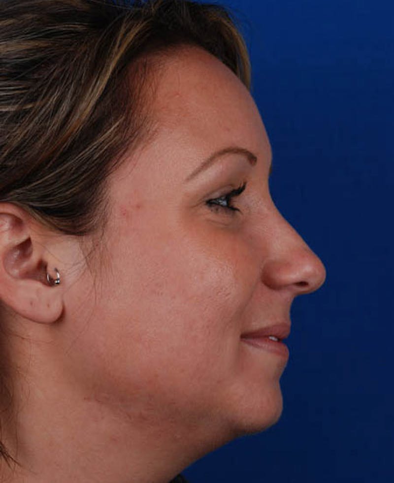 Rhinoplasty Before & After Gallery - Patient 12974047 - Image 3