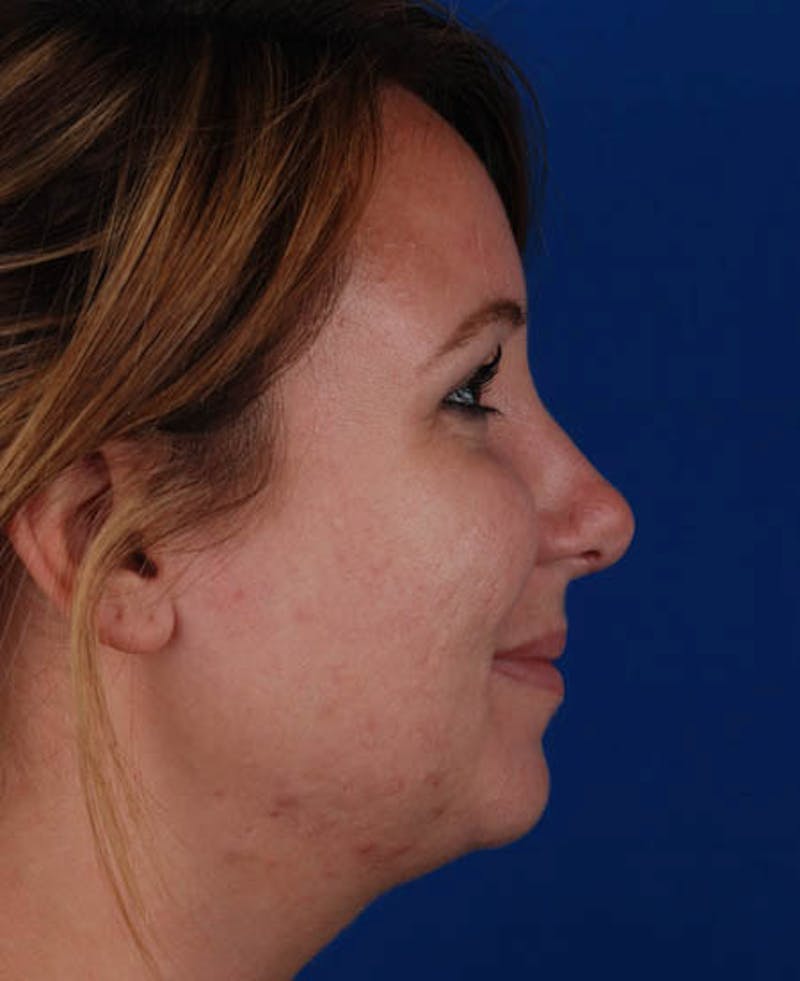 Rhinoplasty Before & After Gallery - Patient 12974047 - Image 4