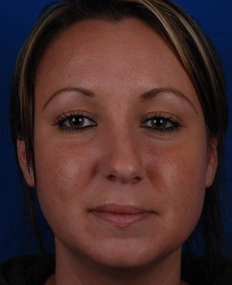 Rhinoplasty Before & After Gallery - Patient 12974047 - Image 5
