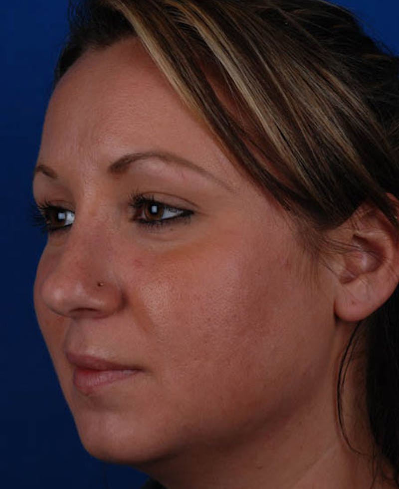 Rhinoplasty Before & After Gallery - Patient 12974047 - Image 7