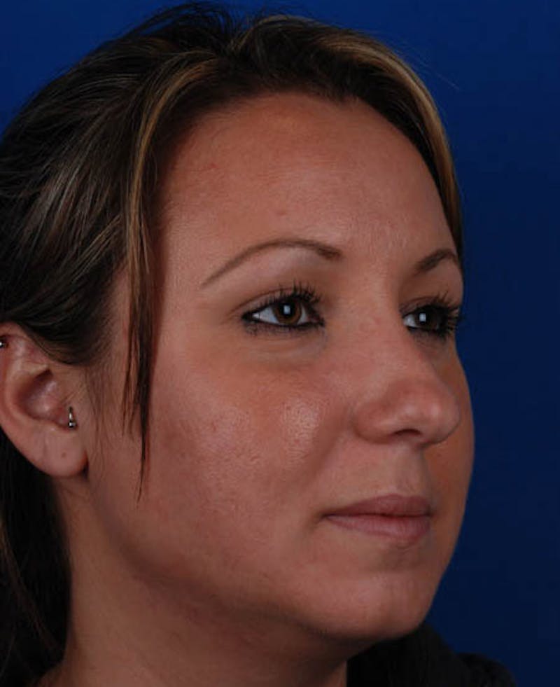 Rhinoplasty Before & After Gallery - Patient 12974047 - Image 9