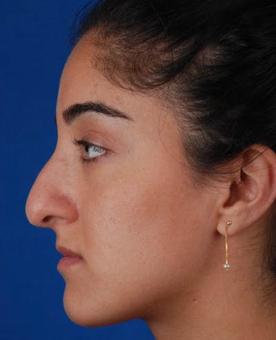 Rhinoplasty Before & After Gallery - Patient 12974049 - Image 1