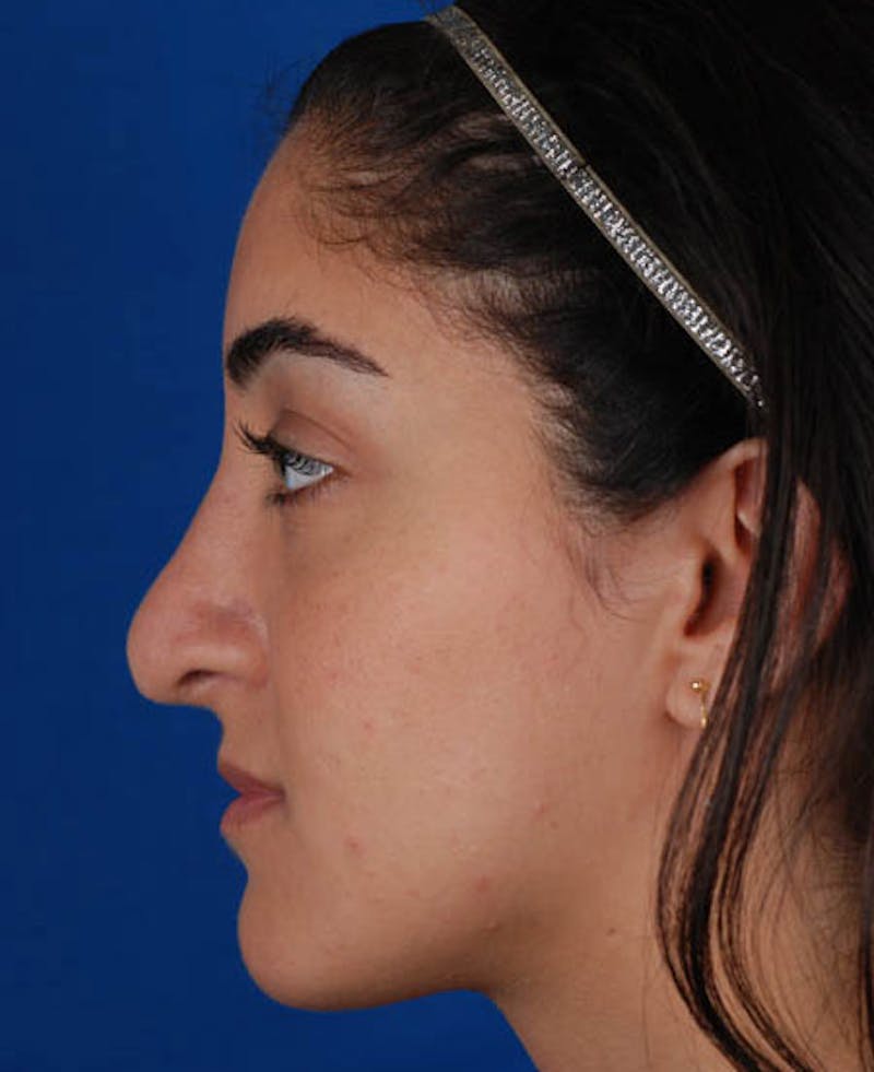 Rhinoplasty Before & After Gallery - Patient 12974049 - Image 2