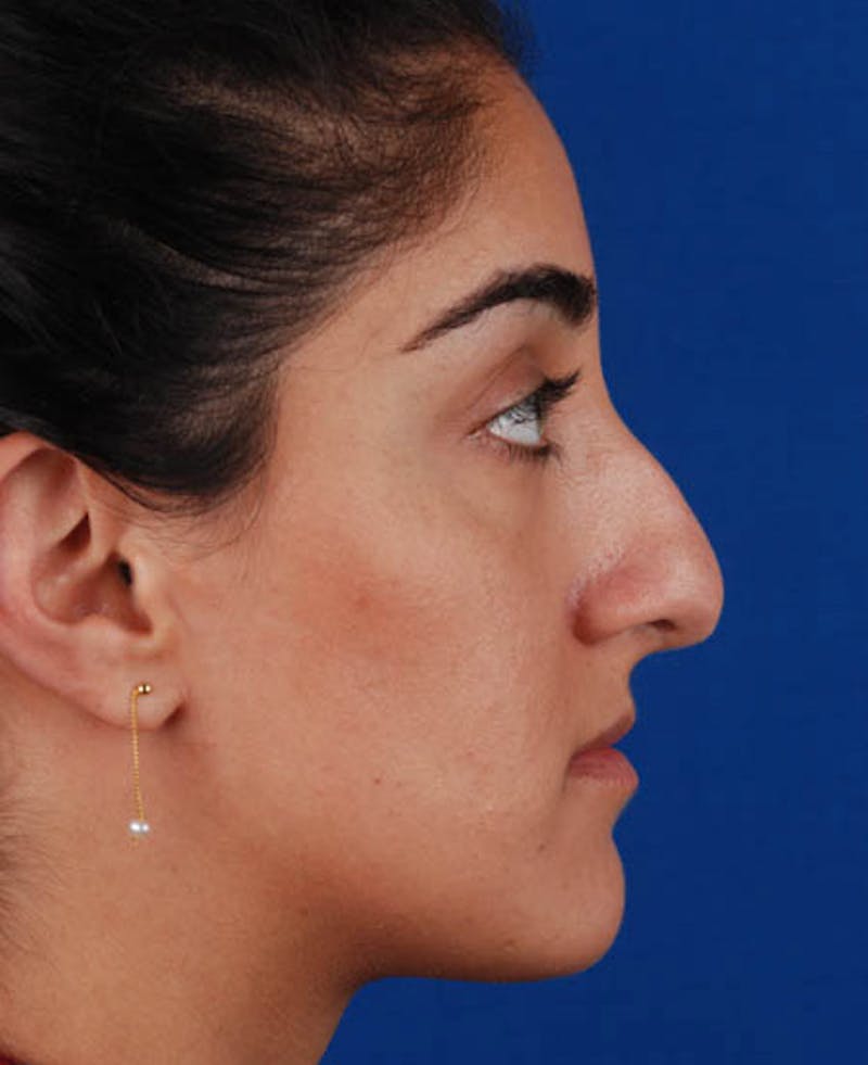 Rhinoplasty Before & After Gallery - Patient 12974049 - Image 3