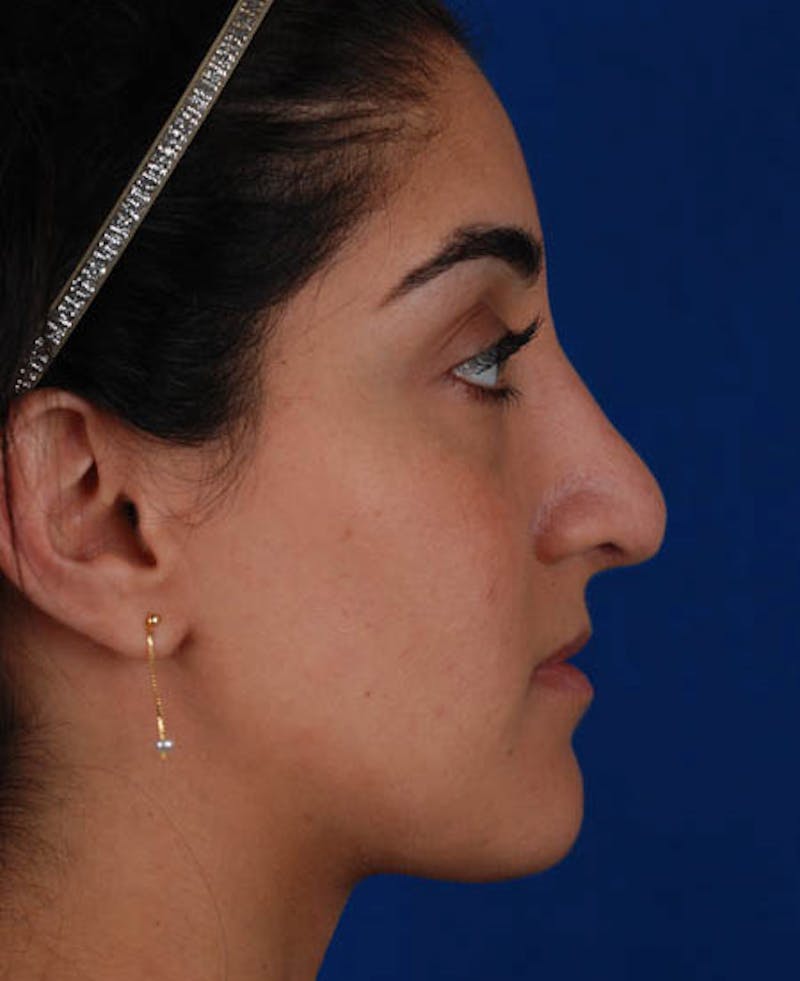 Rhinoplasty Before & After Gallery - Patient 12974049 - Image 4
