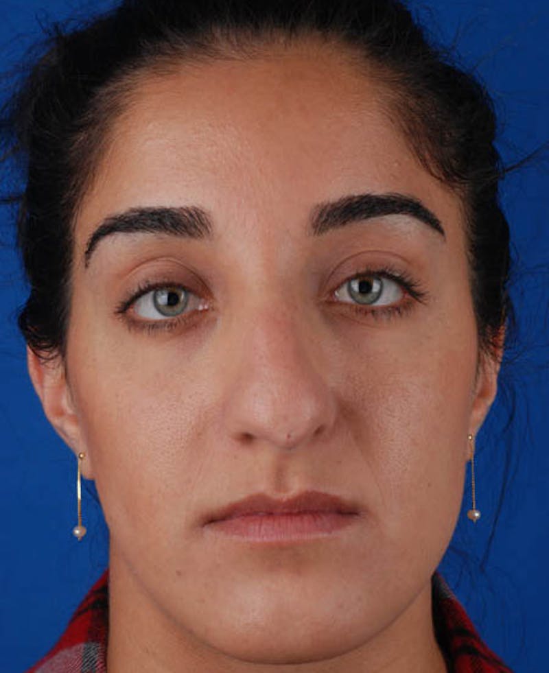 Rhinoplasty Before & After Gallery - Patient 12974049 - Image 5