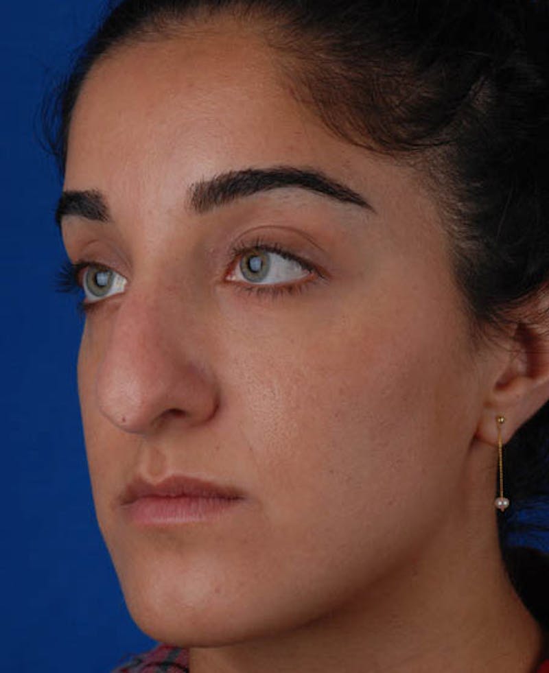 Rhinoplasty Before & After Gallery - Patient 12974049 - Image 7
