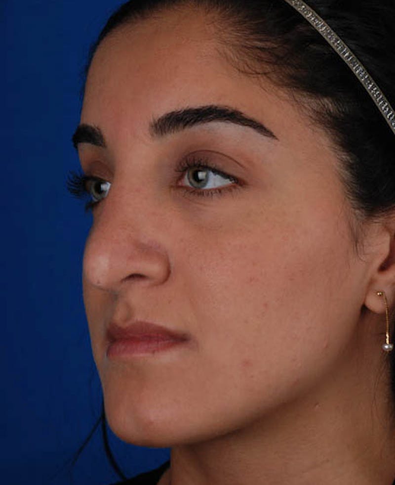 Rhinoplasty Before & After Gallery - Patient 12974049 - Image 8