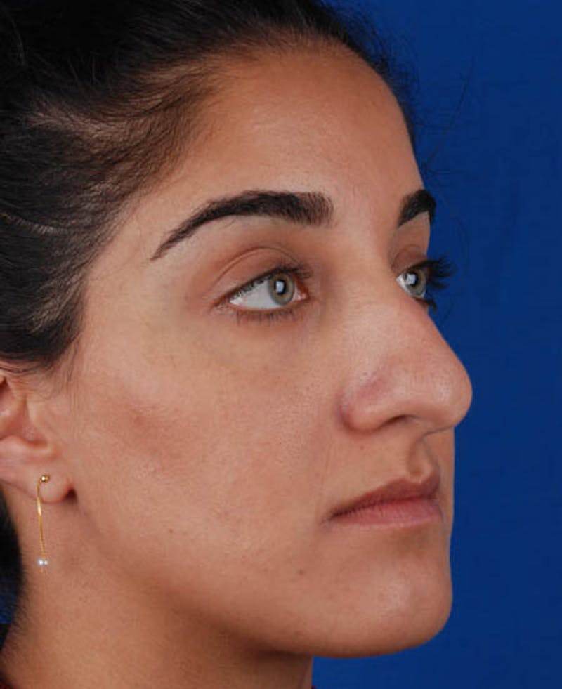 Rhinoplasty Before & After Gallery - Patient 12974049 - Image 9
