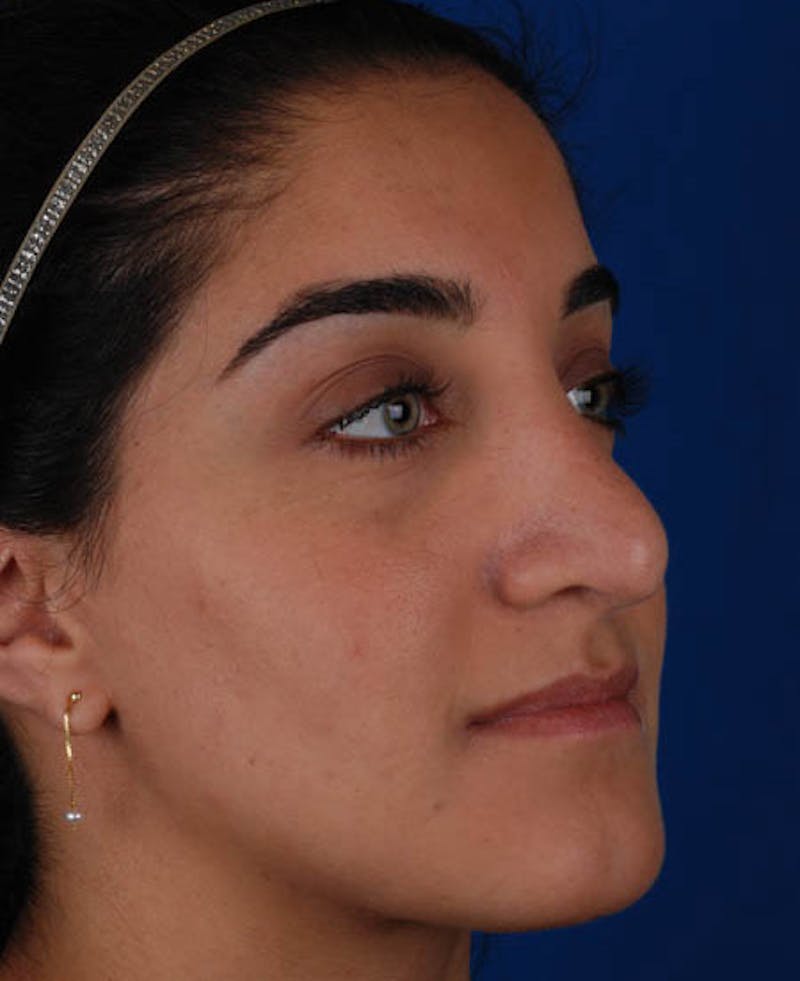 Rhinoplasty Before & After Gallery - Patient 12974049 - Image 10