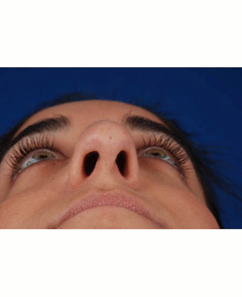 Rhinoplasty Before & After Gallery - Patient 12974049 - Image 11