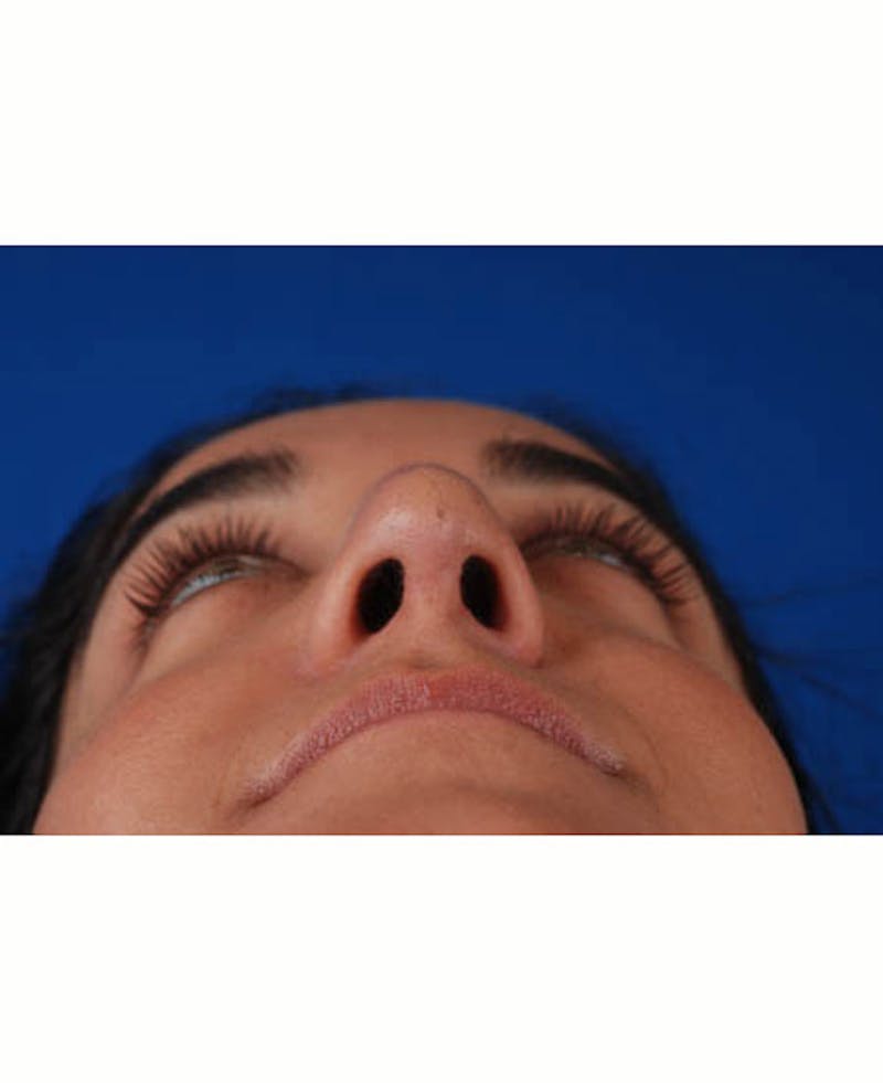 Rhinoplasty Before & After Gallery - Patient 12974049 - Image 12