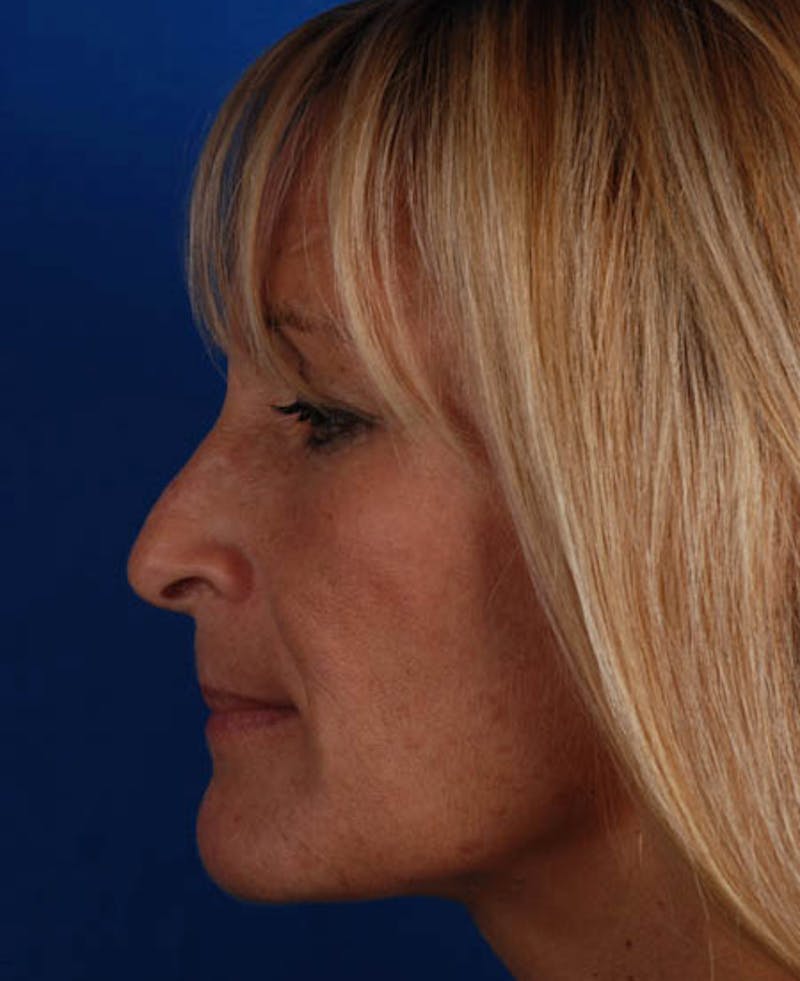 Rhinoplasty Before & After Gallery - Patient 12974051 - Image 1