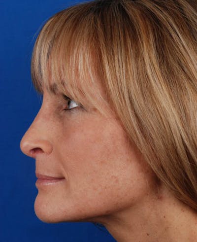 Rhinoplasty Before & After Gallery - Patient 12974051 - Image 2