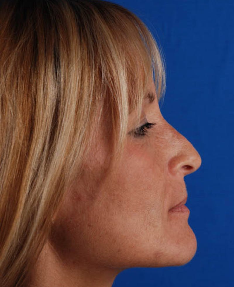 Rhinoplasty Before & After Gallery - Patient 12974051 - Image 3
