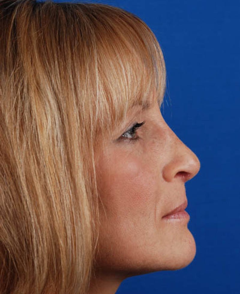 Rhinoplasty Before & After Gallery - Patient 12974051 - Image 4