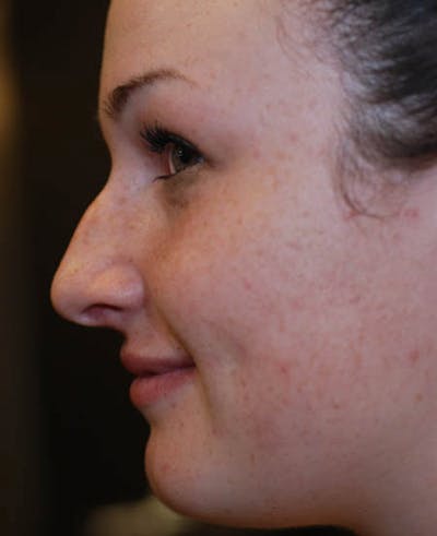 Rhinoplasty Before & After Gallery - Patient 12974054 - Image 1