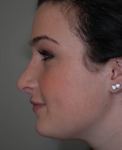 Rhinoplasty Before & After Gallery - Patient 12974054 - Image 2