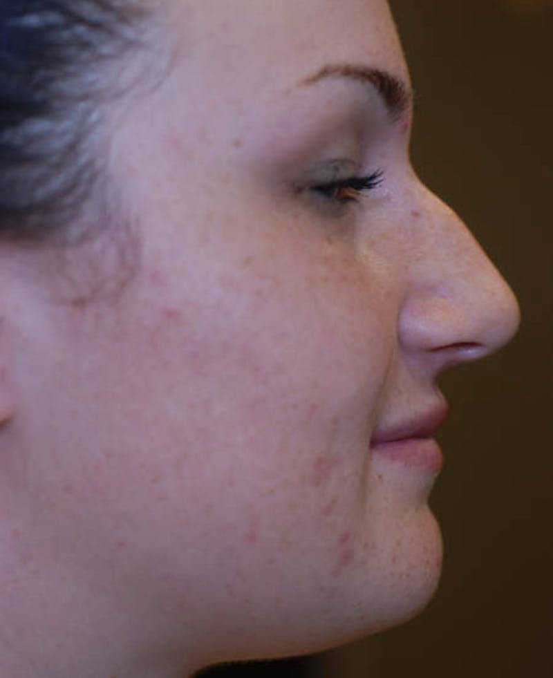 Rhinoplasty Before & After Gallery - Patient 12974054 - Image 3