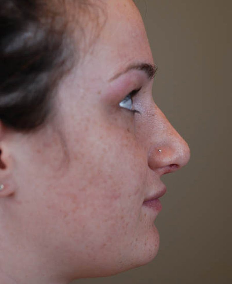 Rhinoplasty Before & After Gallery - Patient 12974054 - Image 4