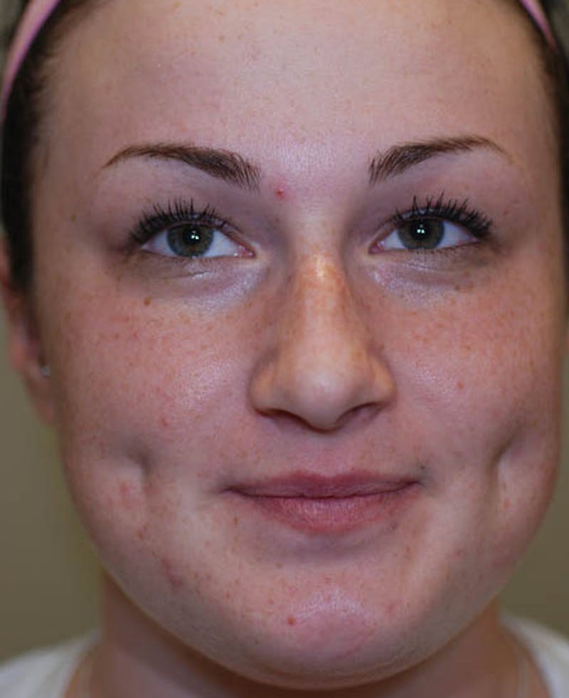 Rhinoplasty Before & After Gallery - Patient 12974054 - Image 5