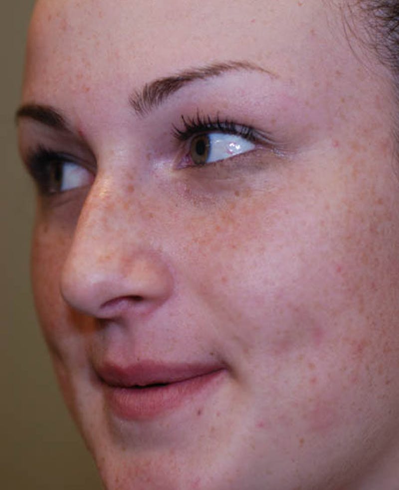 Rhinoplasty Before & After Gallery - Patient 12974054 - Image 7