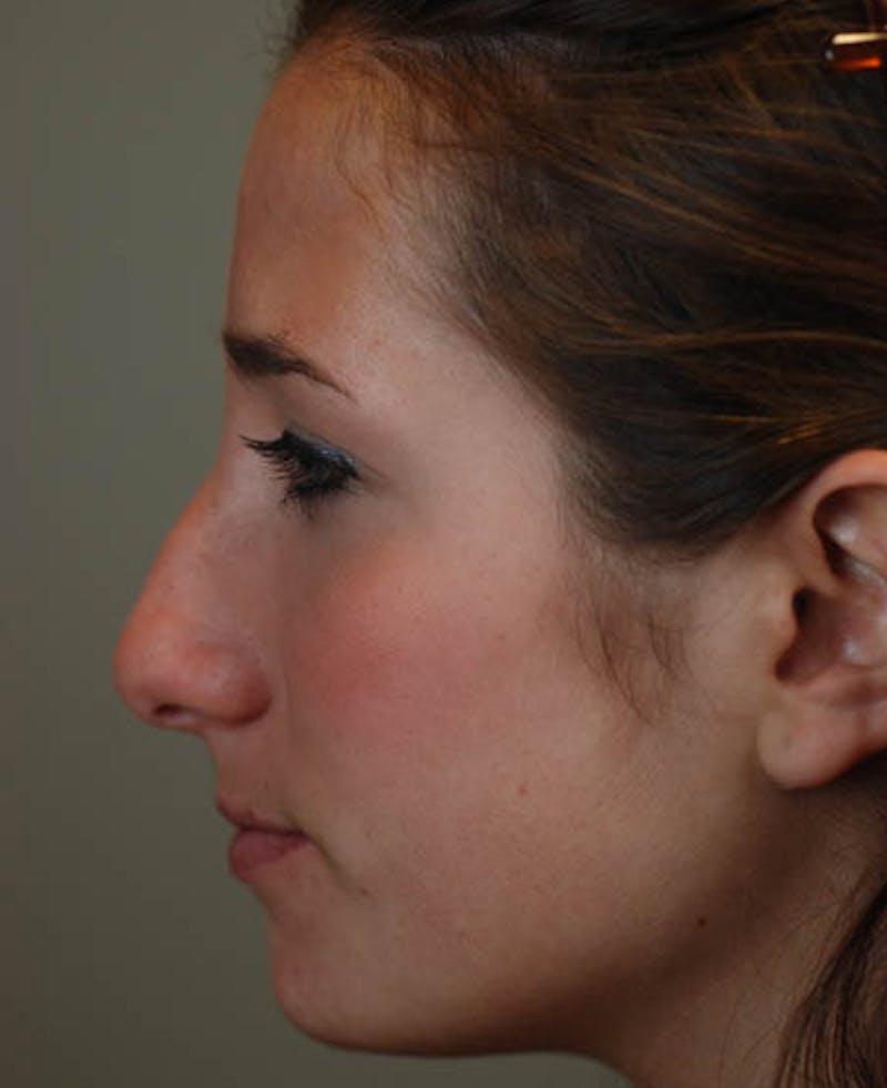 Rhinoplasty Before & After Gallery - Patient 12974056 - Image 1