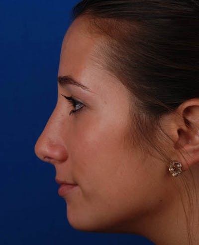 Rhinoplasty Before & After Gallery - Patient 12974056 - Image 2