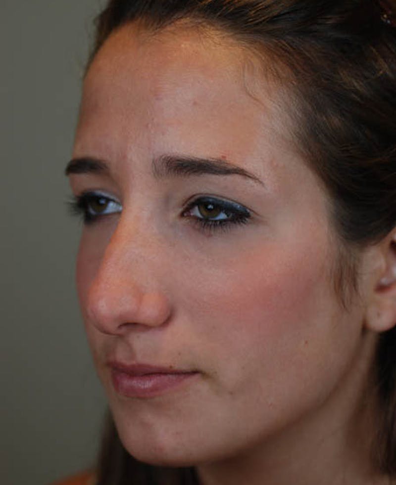 Rhinoplasty Before & After Gallery - Patient 12974056 - Image 3