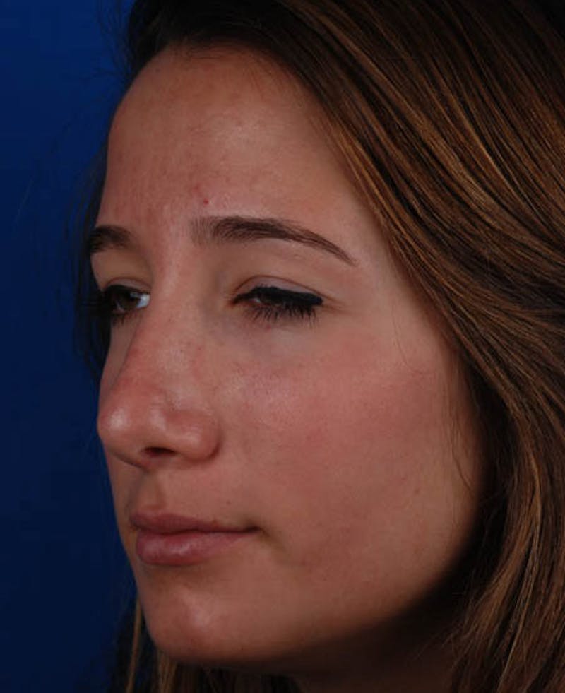 Rhinoplasty Before & After Gallery - Patient 12974056 - Image 4