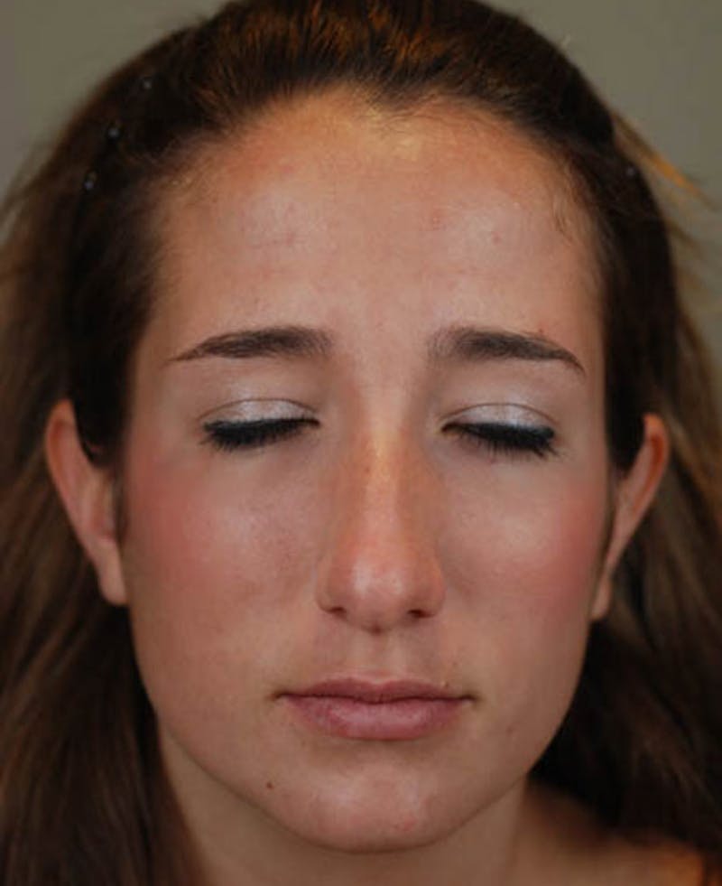 Rhinoplasty Before & After Gallery - Patient 12974056 - Image 5
