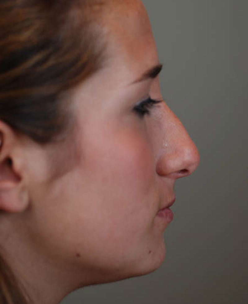 Rhinoplasty Before & After Gallery - Patient 12974056 - Image 7