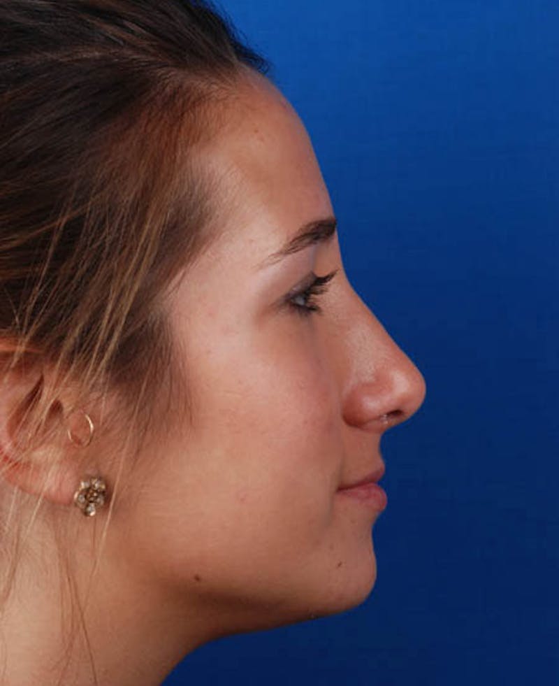 Rhinoplasty Before & After Gallery - Patient 12974056 - Image 8