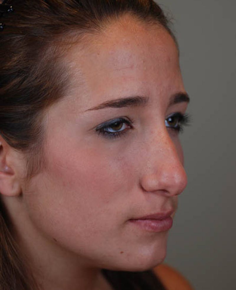Rhinoplasty Before & After Gallery - Patient 12974056 - Image 9