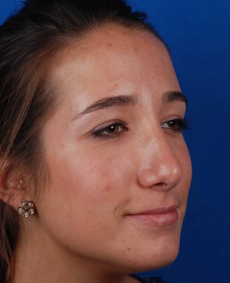 Rhinoplasty Before & After Gallery - Patient 12974056 - Image 10