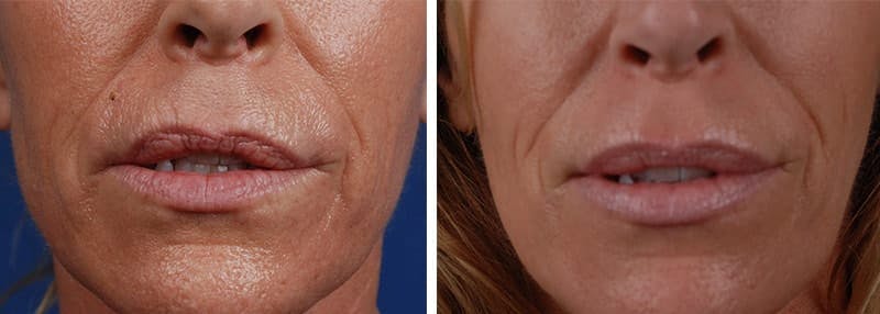 Volbella Redondo Beach