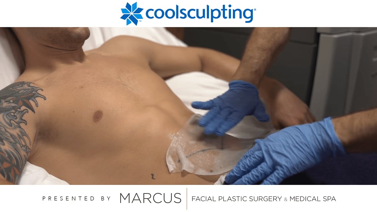 CoolSculpting Manhattan Beach