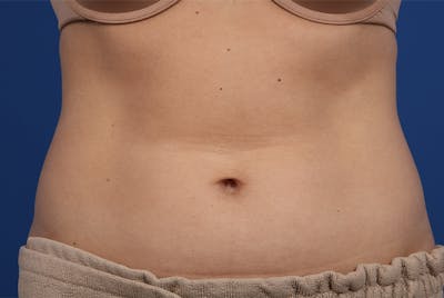 Coolsculpting Before & After Gallery - Patient 20433955 - Image 1