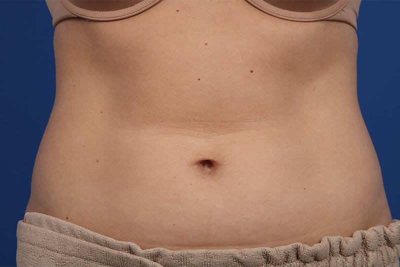 Coolsculpting Gallery - Patient 20433955 - Image 1