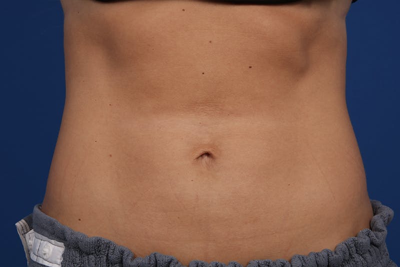 Coolsculpting Before & After Gallery - Patient 20433955 - Image 2
