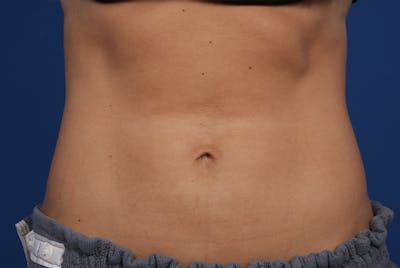 Coolsculpting Before & After Gallery - Patient 20433955 - Image 2