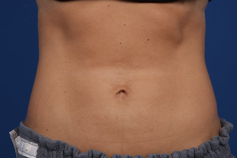 Coolsculpting Gallery - Patient 20433955 - Image 2