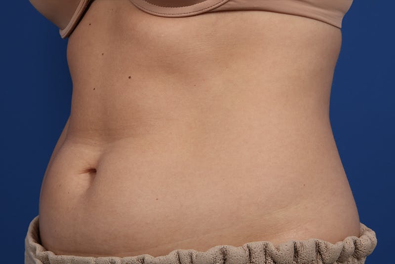 Coolsculpting Gallery - Patient 20433955 - Image 3