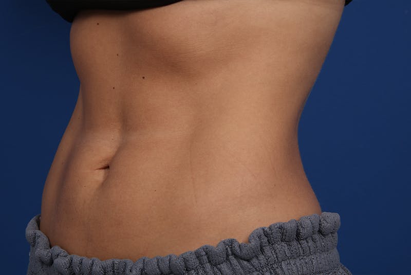 Coolsculpting Before & After Gallery - Patient 20433955 - Image 4
