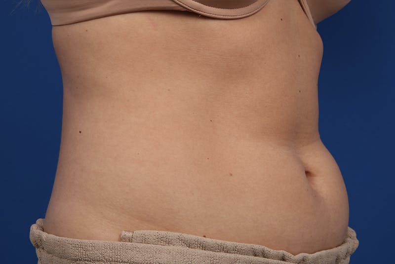Coolsculpting Gallery - Patient 20433955 - Image 5