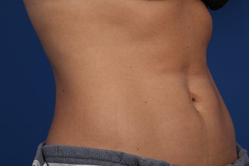 Coolsculpting Before & After Gallery - Patient 20433955 - Image 6