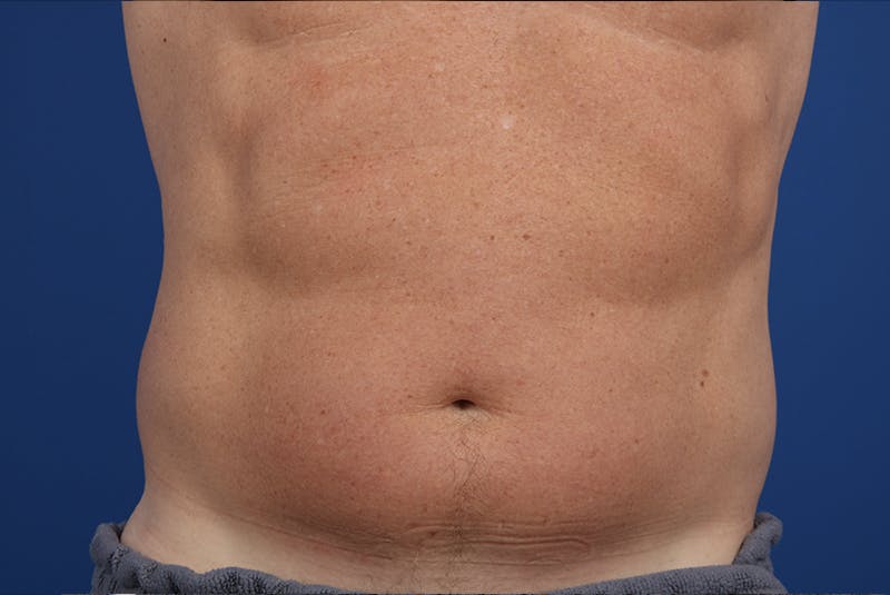 Coolsculpting Gallery - Patient 20437143 - Image 1
