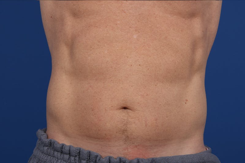 Coolsculpting Before & After Gallery - Patient 20437143 - Image 2